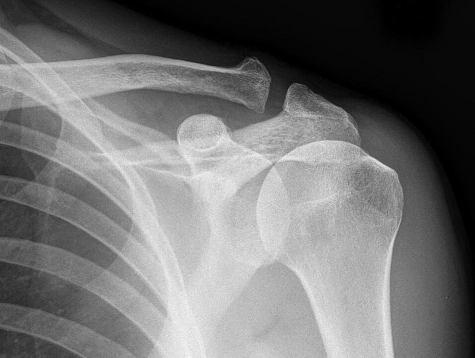 Arthrose des Schultergelenks auf meinem Röntgenbild