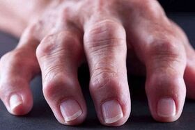 Die Hauptunterschiede bei Arthritis und Arthrose