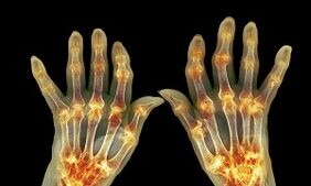 Was ist der Unterschied zwischen Arthrohrose -Arthritis der Gelenke