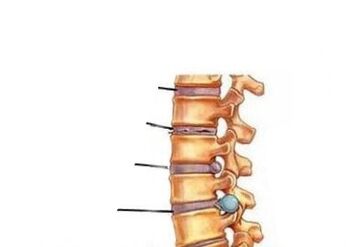 Vier Stadien der Osteochondrose -Entwicklung